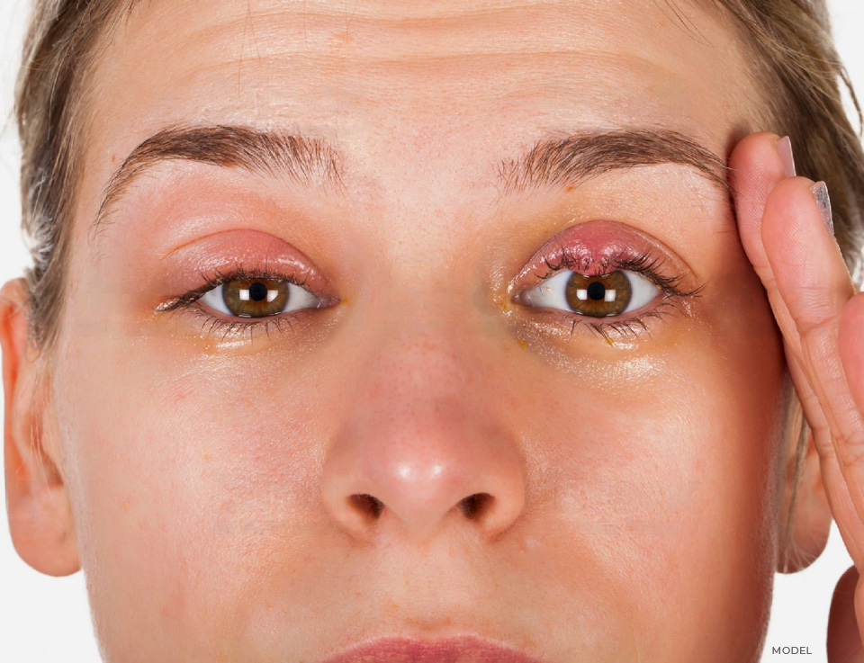 stock image of showing tumor on eye