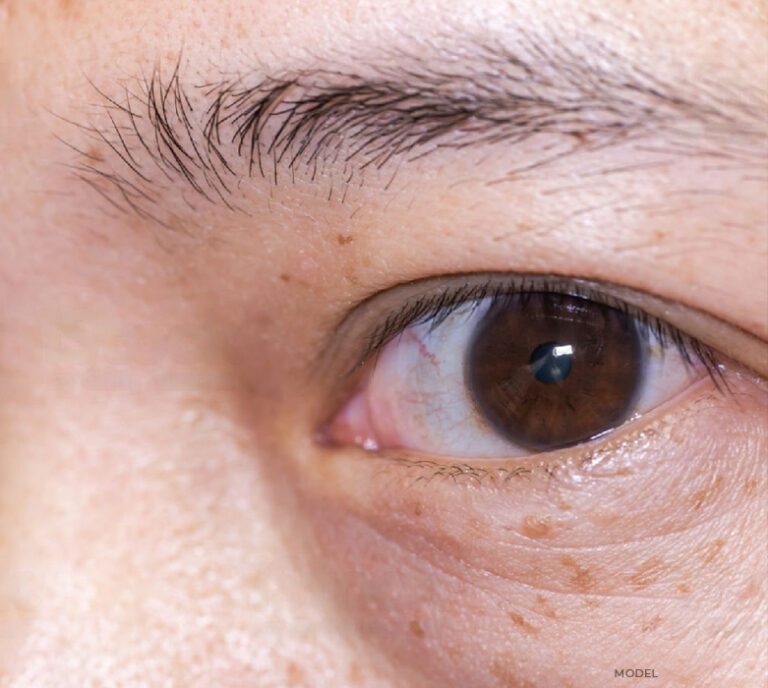 Grave's Disease Treatment Chicago Oculofacial Consultants