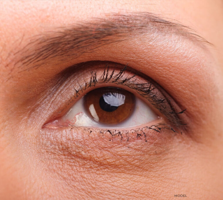 Under Eye Bags Removal Chicago Oculofacial Consultants